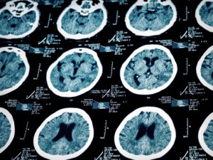Drug Trials Beginning 2nd Phase Are Proving Effective for Victims of Stroke and Traumatic Brain Injury