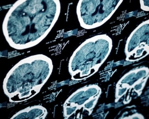 TBI Makes You More Likely to Have a Stroke