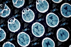 Do Women Experience Traumatic Brain Injuries Differently Than Men?