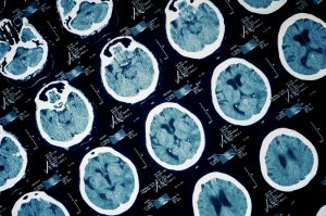 5 Signs That You Need a Brain Injury Lawyer After an Accident