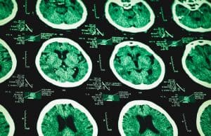 New Research Creating Hope that Doctors Will Have More Time to Respond to Brain Damage