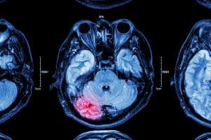 What Factors are Considered When Settling a Traumatic Brain Injury Case