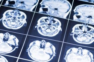 A Discussion on Recent Advancements in Helping Victims of a Traumatic Brain Injury