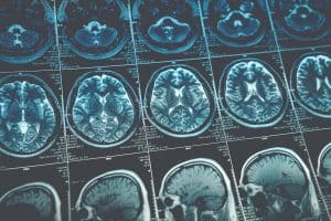 Common Brain Injuries after Motor Vehicle Accidents